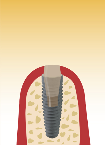 Zahnarzt-Dr.-Ghazal-und-Kollegen-Zahnarztpraxis-Duisburg-Oberhausen-Implantologie-Oralchirurchie-Zahnästhetik-Do-Zahn-we-do-it-Implantologie-Häufige-Fragen-und-Antworten-Info_1